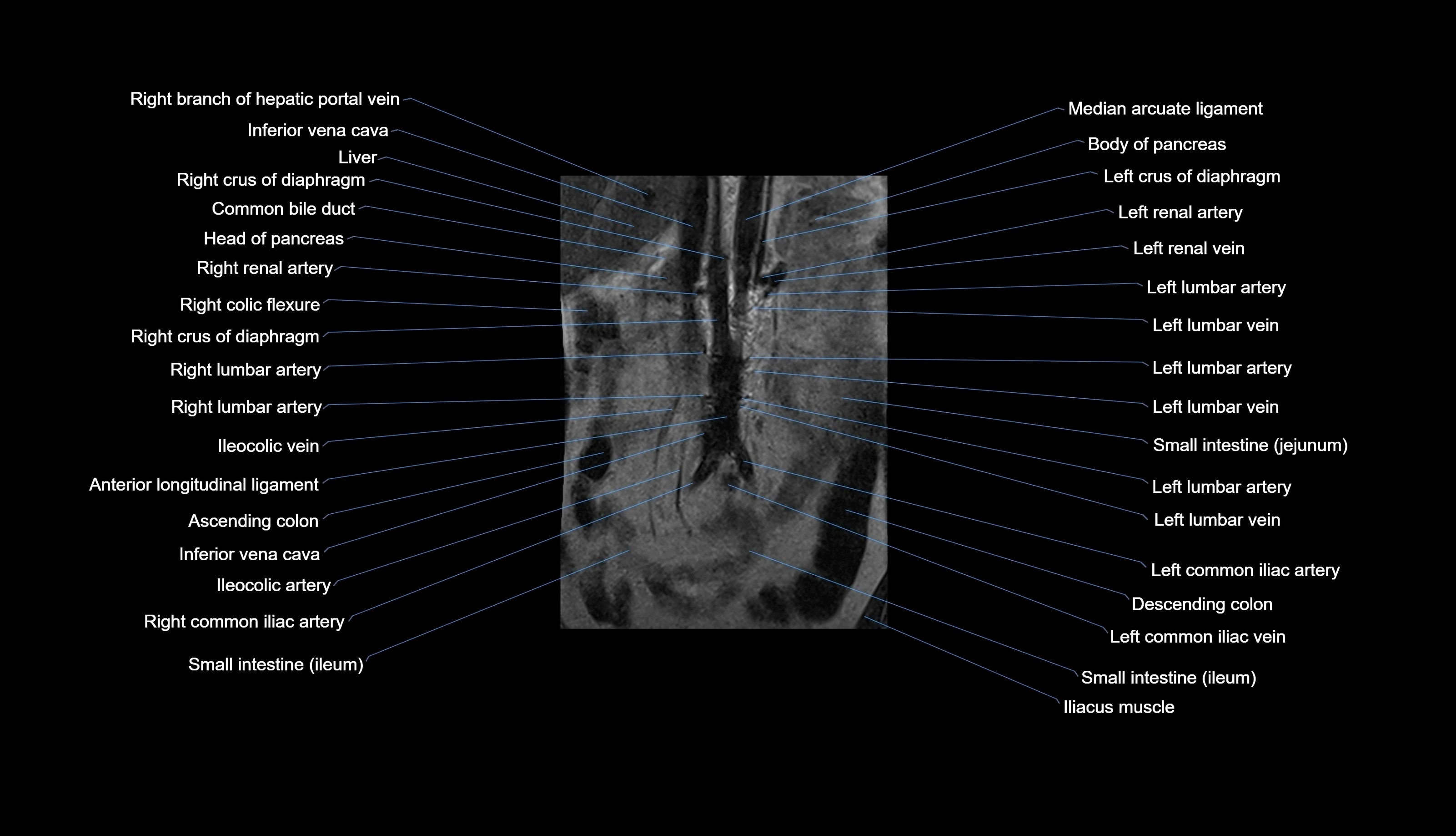 MRI lumbar spine labelled coronal cross sectional anatomy 3T radiology-img-00001-00003.webp